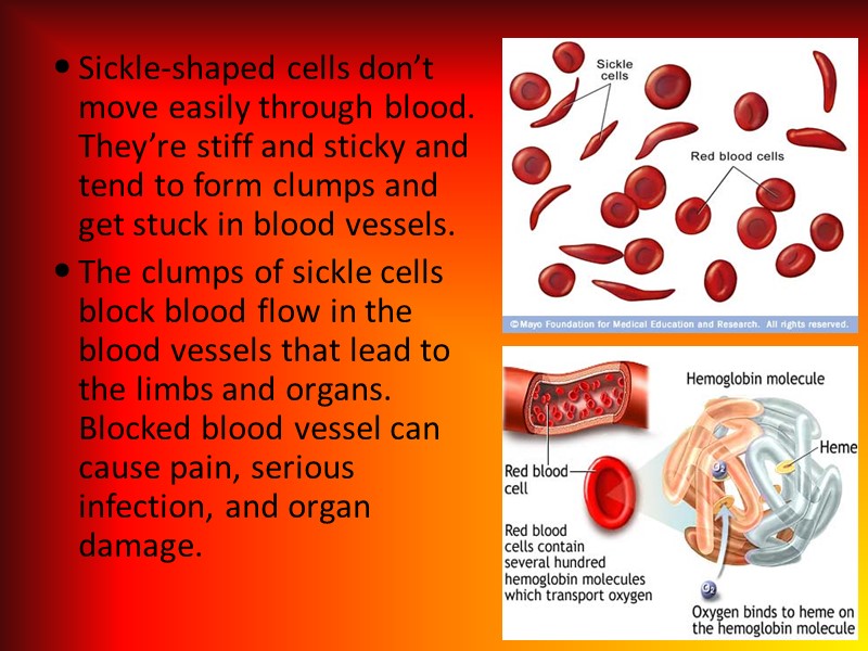 Sickle-shaped cells don’t move easily through blood. They’re stiff and sticky and tend to